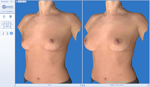 BreastSculptorReview Vectra XT Fot. Lux Med