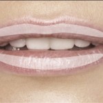 Restylane Restylane