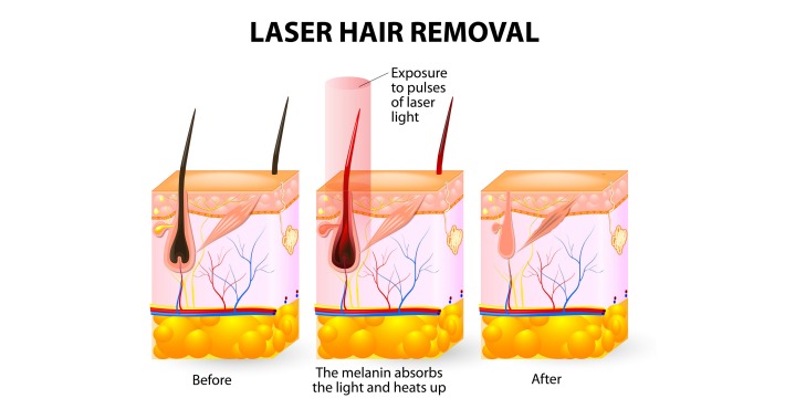 Laser Hair Ramoval Fot 123RF
